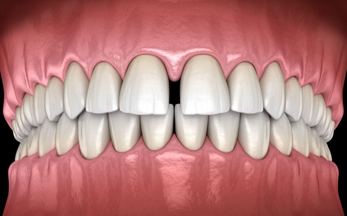 Diastema - רווח בשיניים