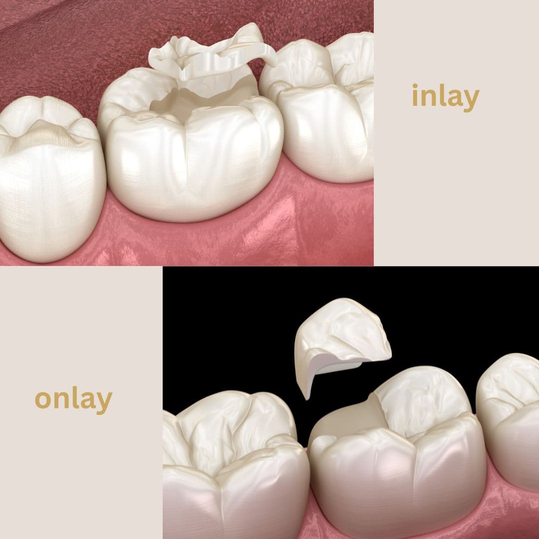 Inlay ו-Onlay