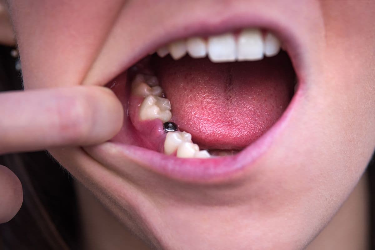 Osseointegration