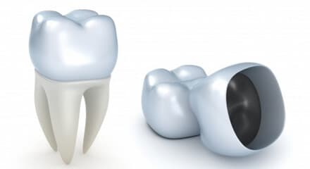 כתר חרסינה — הדמיית כתר לשן